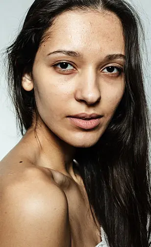 Gözaltı Işık Dolgusu Öncesi Sonrası