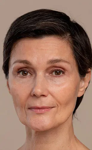 Ameliyatsız Yüz Estetiği Öncesi Sonrası