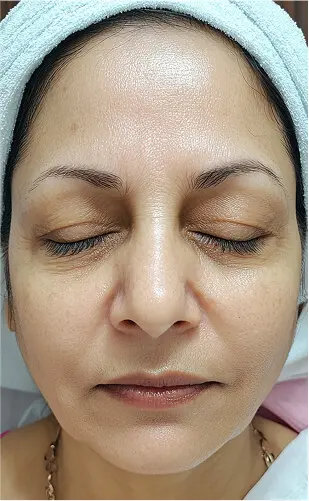 Yüz Dolgusu Öncesi Sonrası