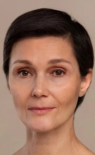 Ameliyatsız Yüz Estetiği Öncesi Sonrası